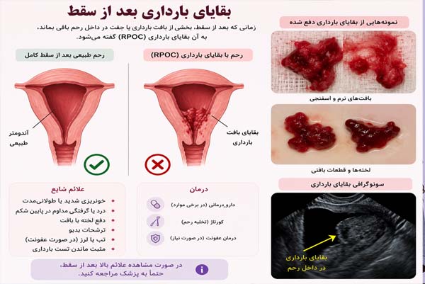 بقایای بارداری بعد از سقط %%sep%% علائم بقایای بارداری %%sep%% درد رحم بعد از سقط %%sep%% تخلیه ناقص رحم %%sep%% قرص دفع بقابا یعد از سقط